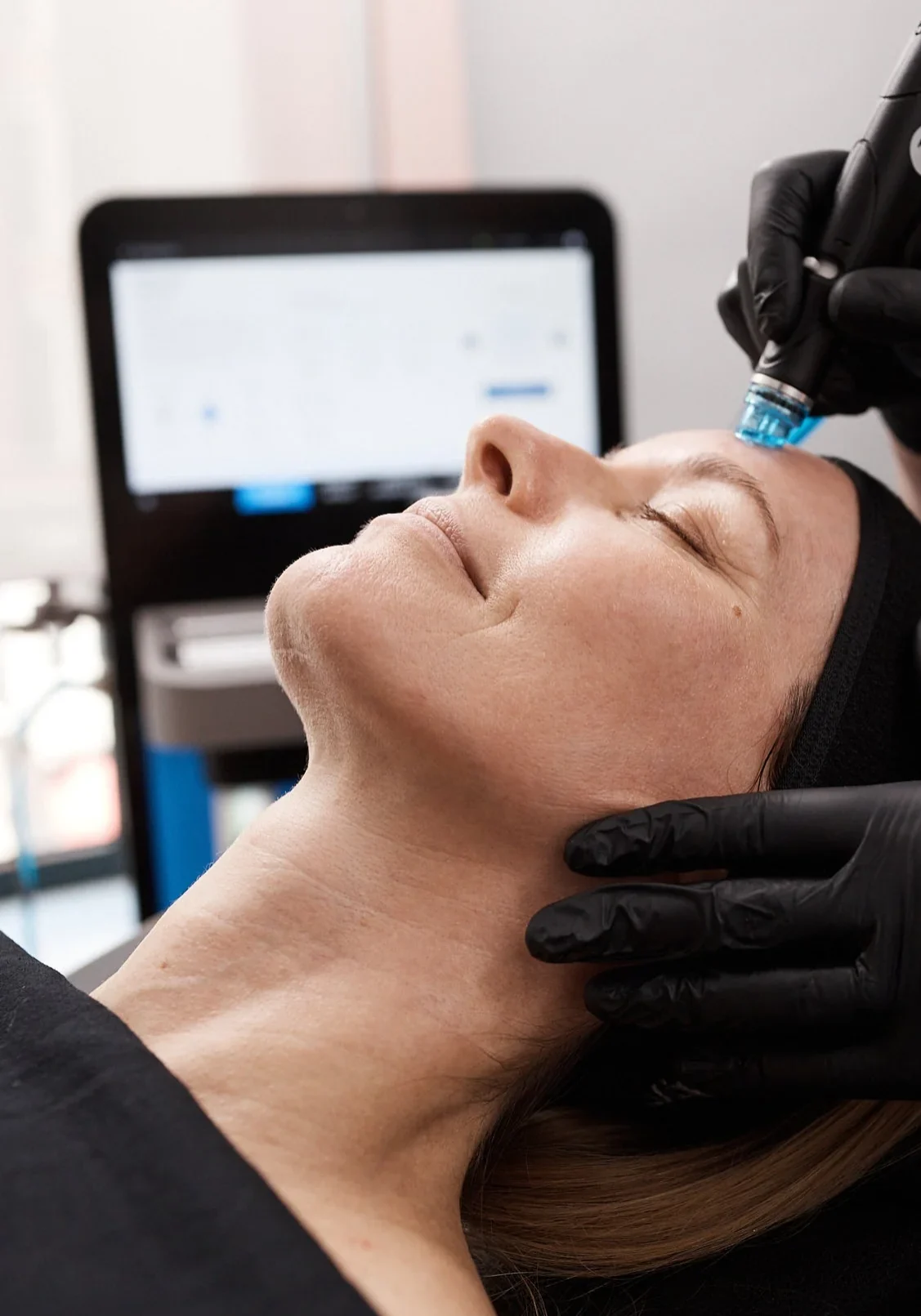 Step_2_Microderm_02